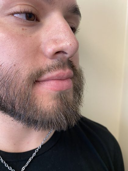 Filler Before & After Patient #4413