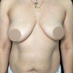 Tummy Tuck Before & After Patient #4359
