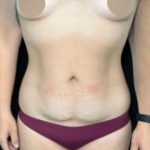 Tummy Tuck Before & After Patient #4353