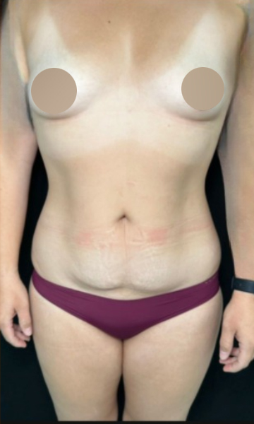 Tummy Tuck Before & After Patient #4353