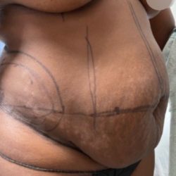 Tummy Tuck Before & After Patient #4357