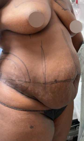 Tummy Tuck Before & After Patient #4357