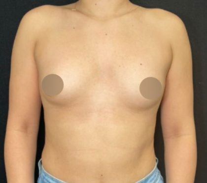 Breast Augmentation Before & After Patient #4473