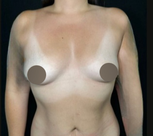 Breast Augmentation Before & After Patient #4475