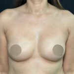 Breast Augmentation Before & After Patient #4476