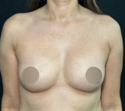 Breast Augmentation Before & After Patient #4476