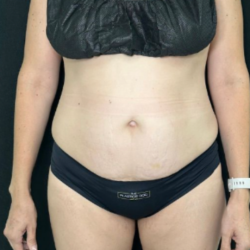 Tummy Tuck Before & After Patient #4352