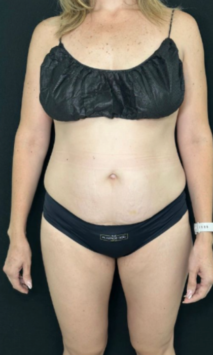 Tummy Tuck Before & After Patient #4352