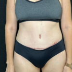 Tummy Tuck Before & After Patient #4352