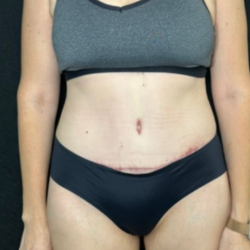 Tummy Tuck Before & After Patient #4352