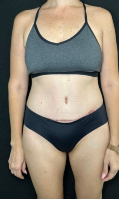 Tummy Tuck Before & After Patient #4352