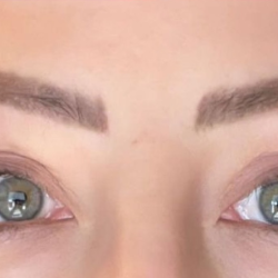 Eyelid Lift Before & After Patient #4440