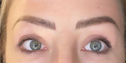 Eyelid Lift Before & After Patient #4440