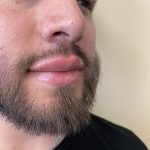 Filler Before & After Patient #4413