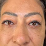 Eyelid Lift Before & After Patient #4434