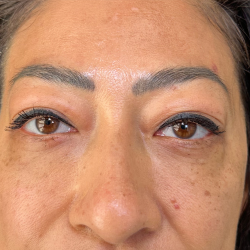 Eyelid Lift Before & After Patient #4434