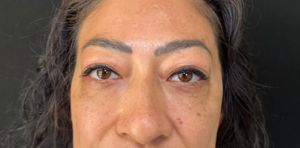 Eyelid Lift Before & After Patient #4434