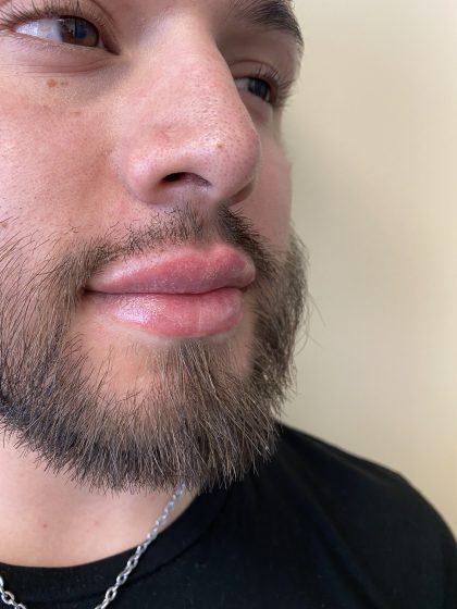 Filler Before & After Patient #4413