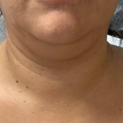 Chin Lipo Before & After Patient #4406
