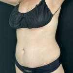 Tummy Tuck Before & After Patient #4352