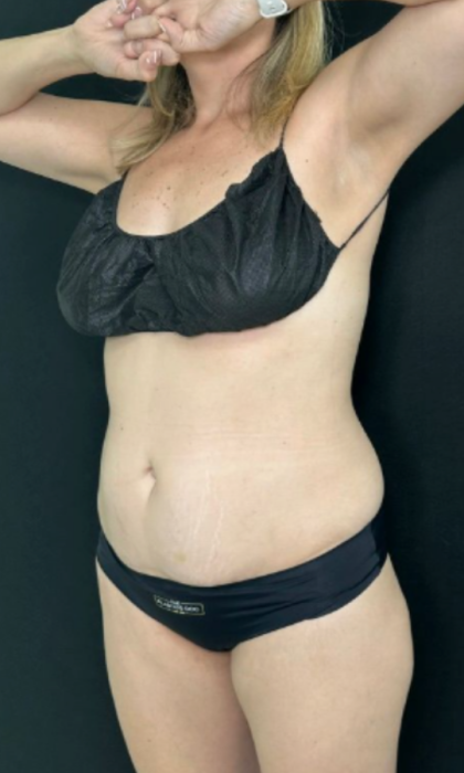 Tummy Tuck Before & After Patient #4352