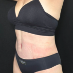Tummy Tuck Before & After Patient #4352