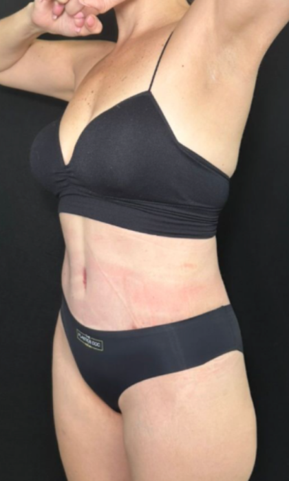 Tummy Tuck Before & After Patient #4352