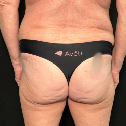 Aveli Before & After Patient #4569