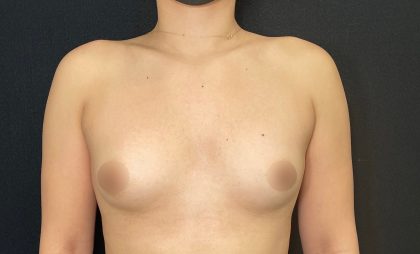 Breast Augmentation Before & After Patient #4555