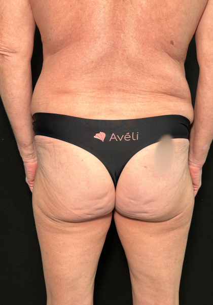 Aveli Before & After Patient #4569