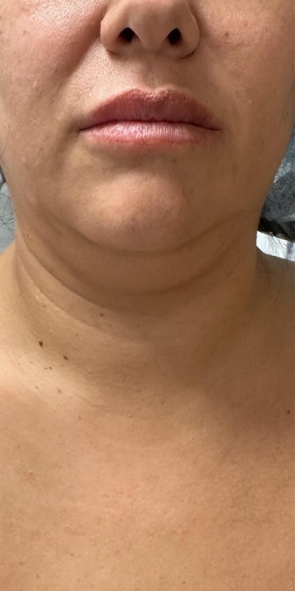 Chin Lipo Before & After Patient #4406