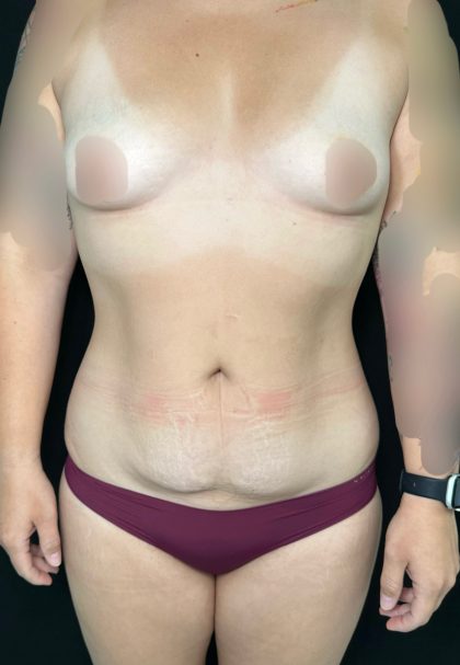 Mommy Makeover Before & After Patient #4565