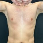 Liposuction Before & After Patient #4574