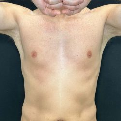 Liposuction Before & After Patient #4574