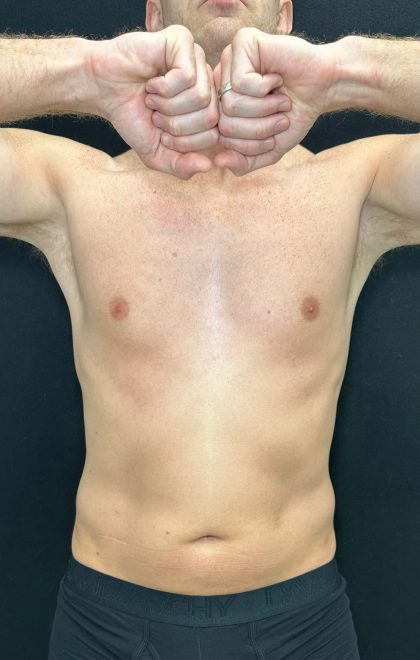 Liposuction Before & After Patient #4574