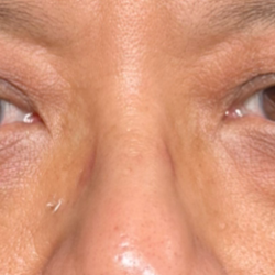 Eyelid Lift Before & After Patient #4441