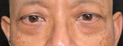 Eyelid Lift Before & After Patient #4441
