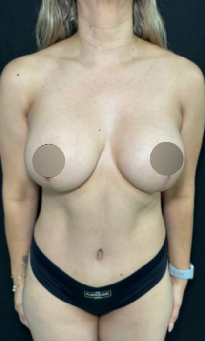 Tummy Tuck Before & After Patient #4359