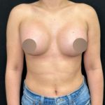 Breast Augmentation Before & After Patient #4473