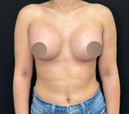 Breast Augmentation Before & After Patient #4473