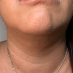 Chin Lipo Before & After Patient #4406