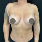 Breast Augmentation Before & After Patient #4475