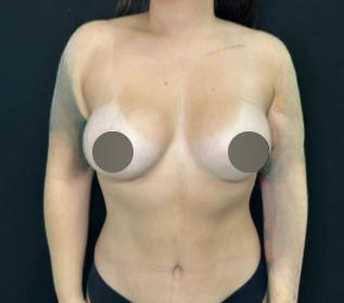 Breast Augmentation Before & After Patient #4475
