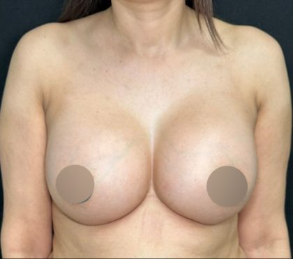 Breast Augmentation Before & After Patient #4476