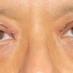 Eyelid Lift Before & After Patient #4441