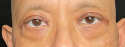 Eyelid Lift Before & After Patient #4441