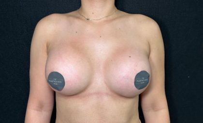 Breast Augmentation Before & After Patient #4555