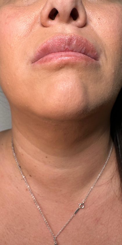 Chin Lipo Before & After Patient #4406