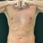 Liposuction Before & After Patient #4574