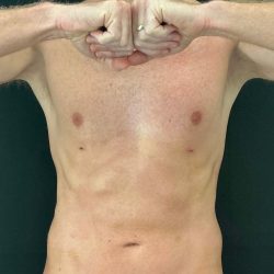 Liposuction Before & After Patient #4574